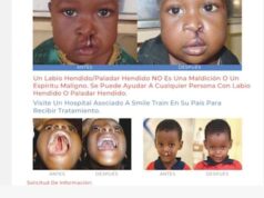 Bata: el Hospital Nuevo INSESO lidera una campaña quirúrgica dirigida a pacientes con labio leporino