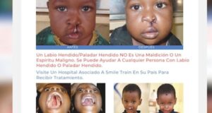 Bata: el Hospital Nuevo INSESO lidera una campaña quirúrgica dirigida a pacientes con labio leporino