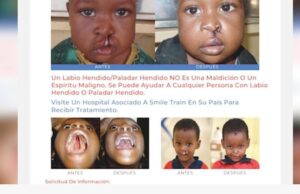 Bata: el Hospital Nuevo INSESO lidera una campaña quirúrgica dirigida a pacientes con labio leporino