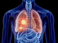 El cáncer de pulmón avanza en silencio: detectarlo a tiempo salva vidas