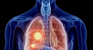 El cáncer de pulmón avanza en silencio: detectarlo a tiempo salva vidas